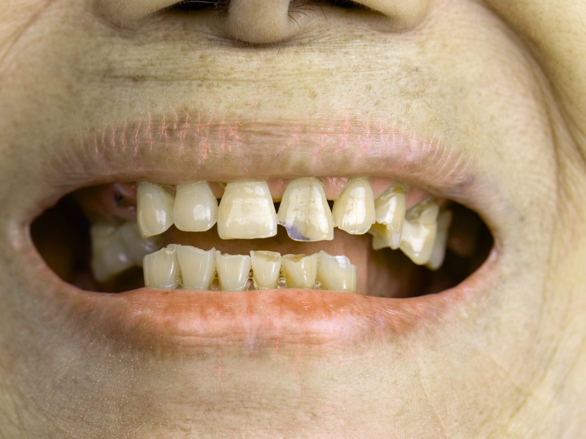 How Acidic Drinks Damage Your Teeth