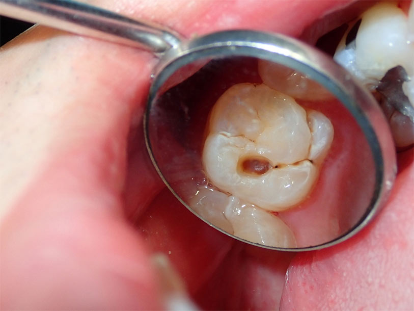 Why Do Teeth Decay explained with bacteria, diet, and oral hygiene