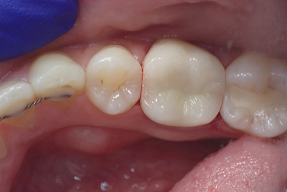 dental crowns natural tooth restoration