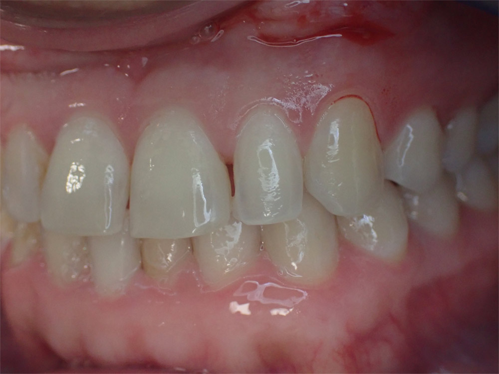 composite veneers vancouver natural smile makeover